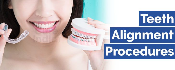Teeth Alignment Procedures